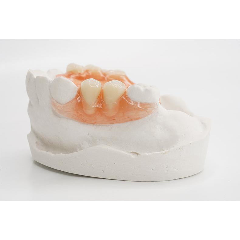 Upper Valplast Rpd Dental Code For Upper Valplast Partial at Emily Jenkins blog